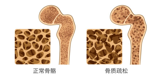 和治友德|世界骨质疏松日:五项注意重在预防